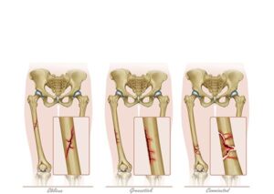 fracturas del hueso femur