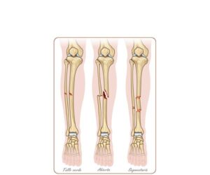 fracturas del hueso tibia
