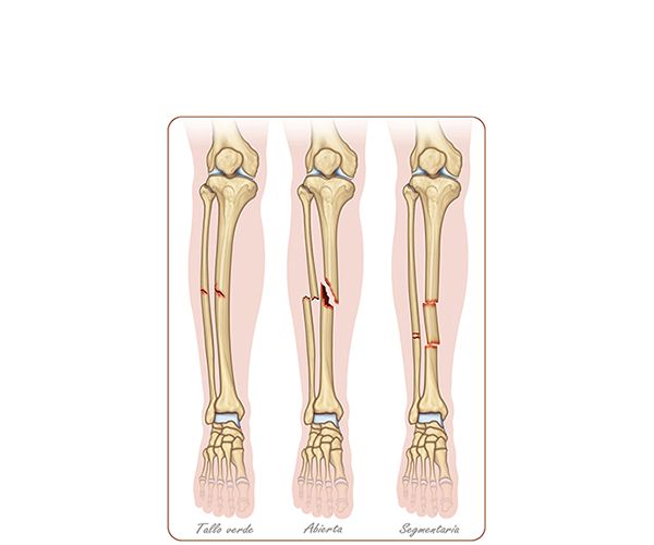 fracturas del hueso tibia fracturas del hueso tibia