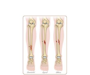 fracturas hueso tibia