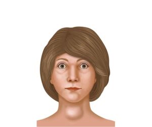 girl with hyperthyroidism