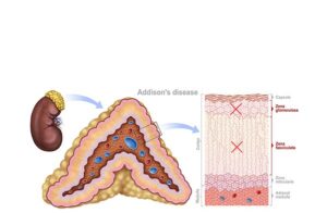 glandula adrenal en adison