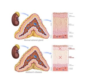 glandula adrenal en enfermedad de adison