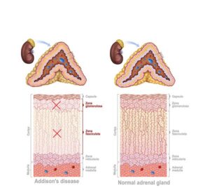 glandula adrenal en la enfermedad de adison