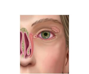 glandula lagrimal en sindrome de sjögren