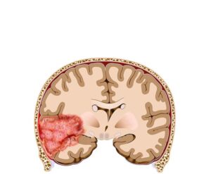 glioblastoma cerebral