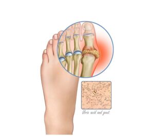 gout of the foot