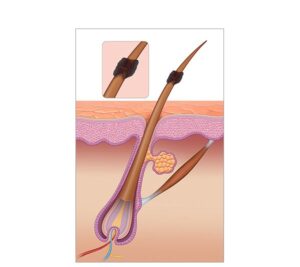 1804.i308.007.p.m005.c15.realistic photoepilation hair removal s