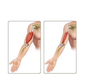 healthy and atrophic muscles