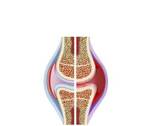 healthy and osteoarthritis knee