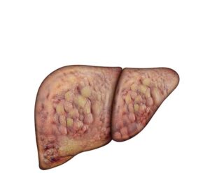 hepatic cirrhosis