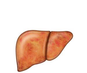 hepatitis autoinmune