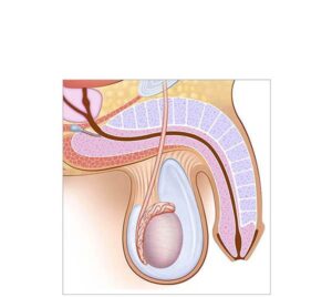 hidrocele