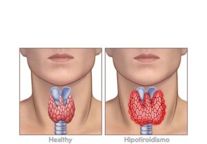 hiperteroidismo
