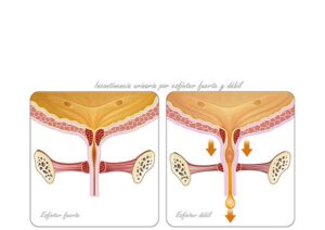 incontinencia urinaria detalle