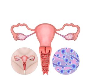 vaginal candidiasis infection