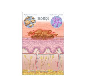 infecciónes de impétigo