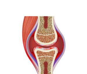 inflamacion de artritis