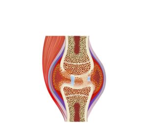 inflamacion de artritis avanzada