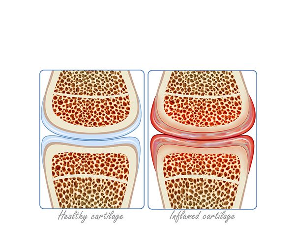 inflamed cartilage inflamed cartilage