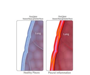 inflamed pulmonary pleura