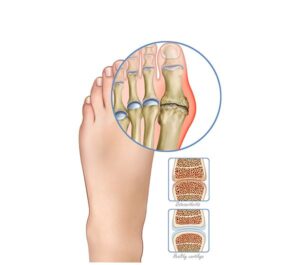inflammation in osteoarthritis
