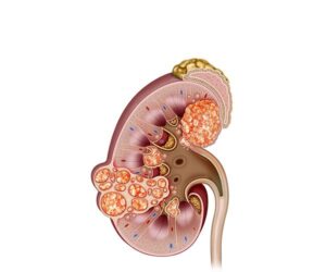 insuficiencia renal