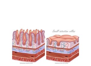 intestinal villus of a celiac