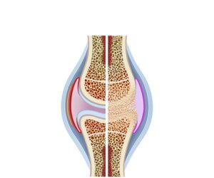 knee and bone ankylosis