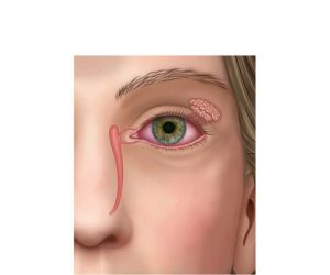 la glandula lagrimal en sindrome de sjögren