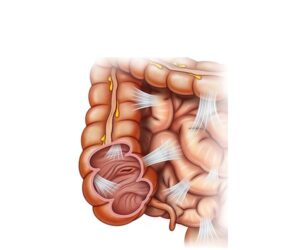 la adhesión abdominal