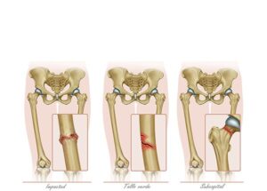lesiones del femur