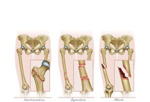 lesiones del hueso femur