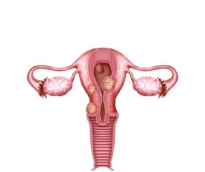 los miomas uterinos