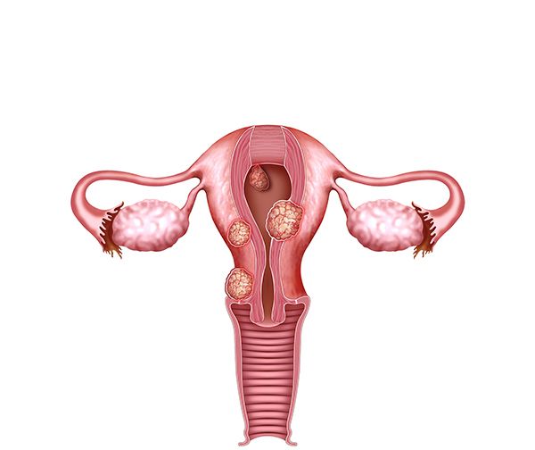 los miomas uterinos los miomas uterinos