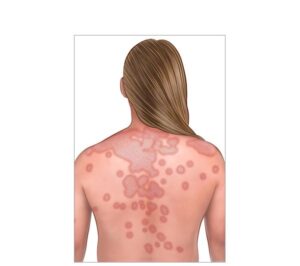 lupus eritematoso sistémico