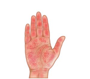 mano con artritis reactiva