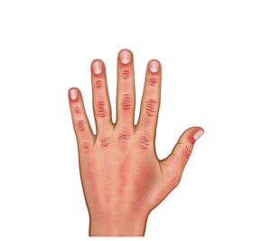 mano con dermatomiositis