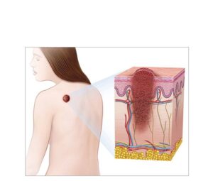 melanoma en espalda