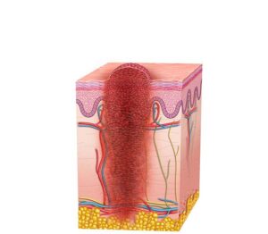 melanoma metastásico