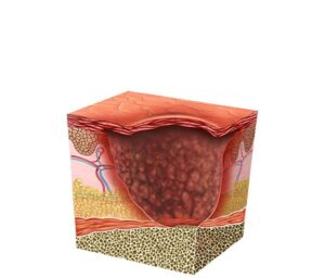 melanoma ulcerado