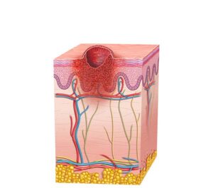 melanoma ulceroso
