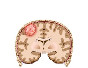 miningioma cerebral