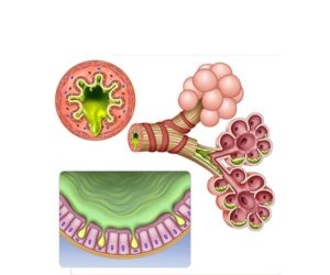 mucosidad alveolar