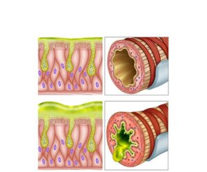 mucuosas alteradas en bronquitis
