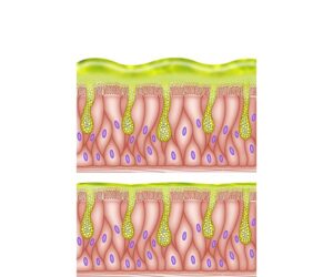 mucuosas alteradas y normales
