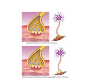 myasthenia gravis neuromuscular synapse