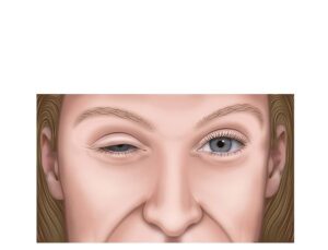ocular myasthenia gravis