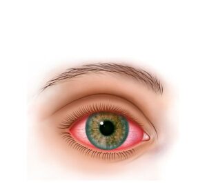 ojo con artritis reactiva