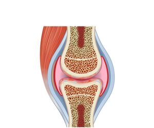 osteoartritis